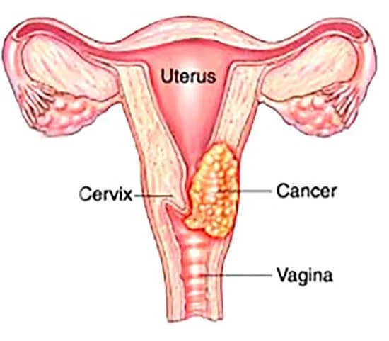 Advanced Cervical Cancer Care in Noida | Dr. Manish Singhal