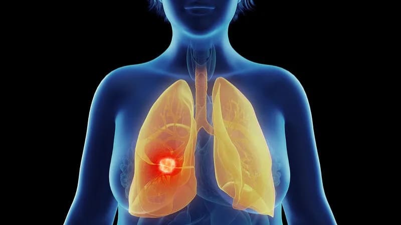 Best Lung Cancer Treatment in Noida by Leading Cancer Experts