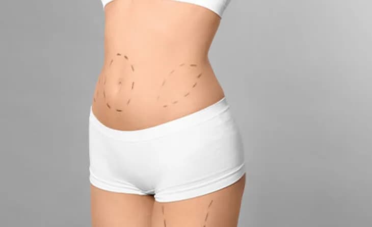 Liposuction Surgery Cost in Delhi - Dr Rajat Gupta