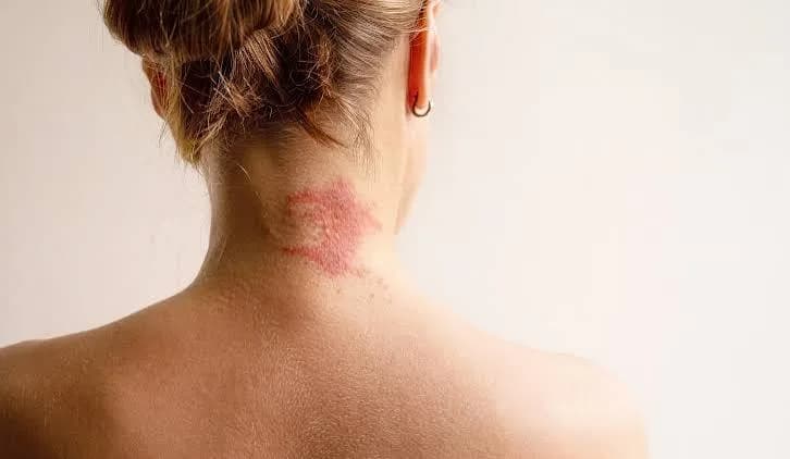 Allergic Inflammation