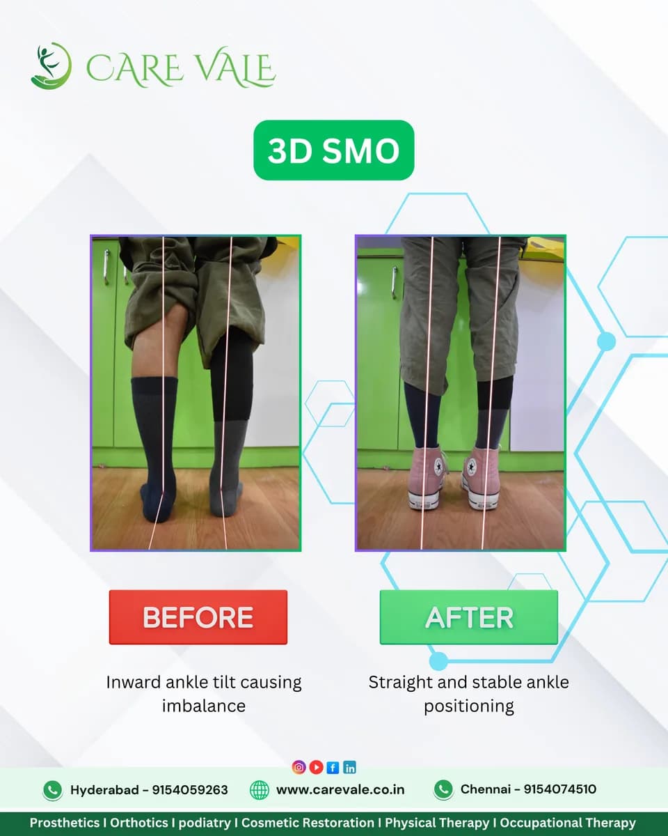 Best Artificial Leg  in Hyderabad | CareVale Prosthetics