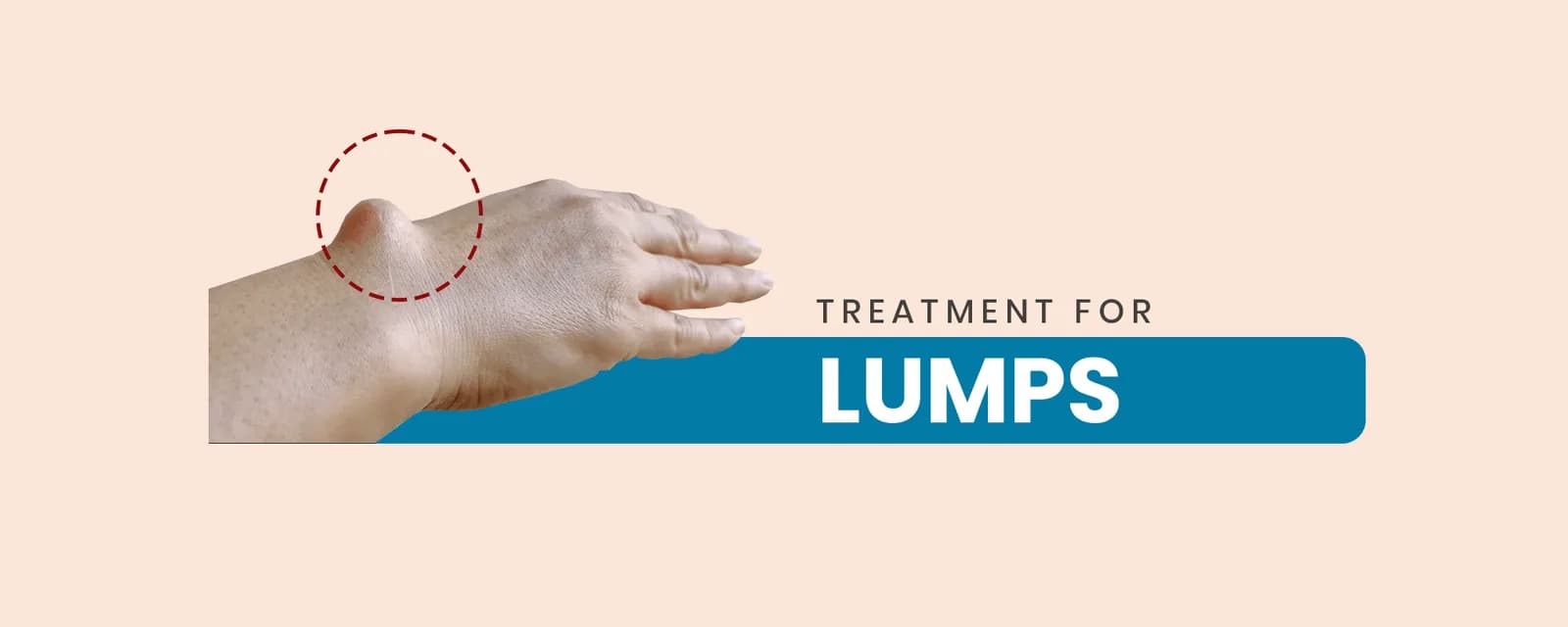Homeopathy treatment for Lumps