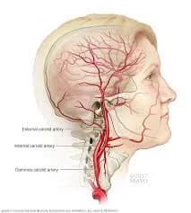  Innovative Methods for Diagnosing and Treating Carotid Artery Stenosis