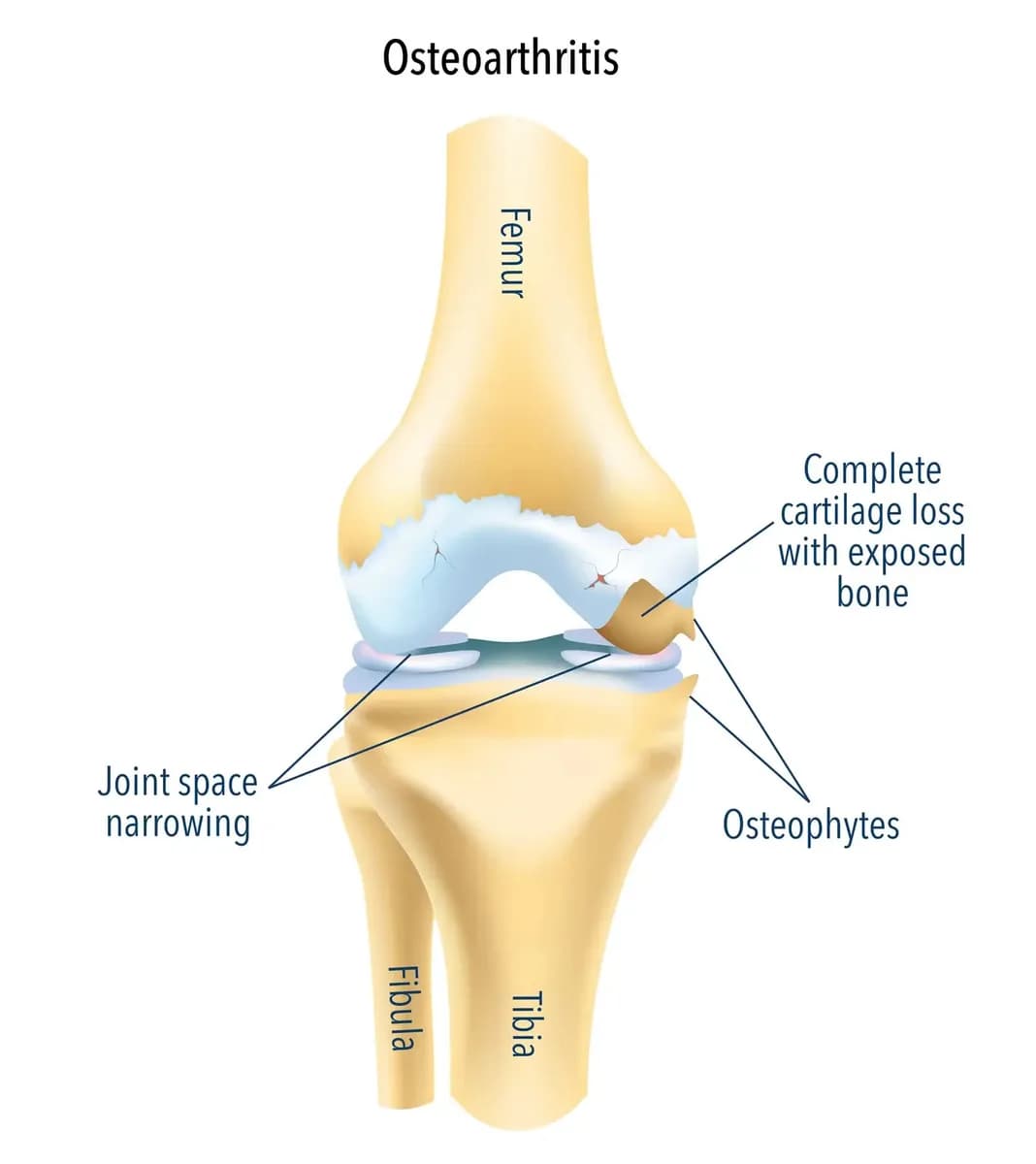 Manage Joint Pain with Osteoarthritis Treatment