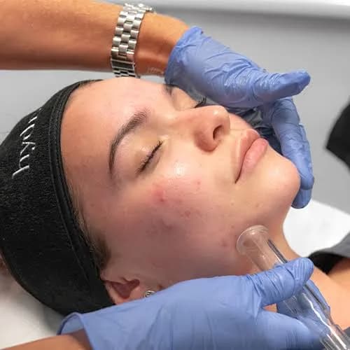 Hydra Facial in Brisbane for Radiant, Healthy Skin