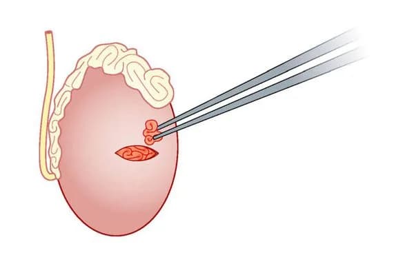 MicroTESE in Delhi for Male Infertility | Fertylity IVF