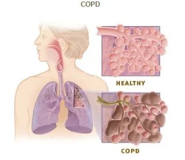 COPD treatment in Singapore