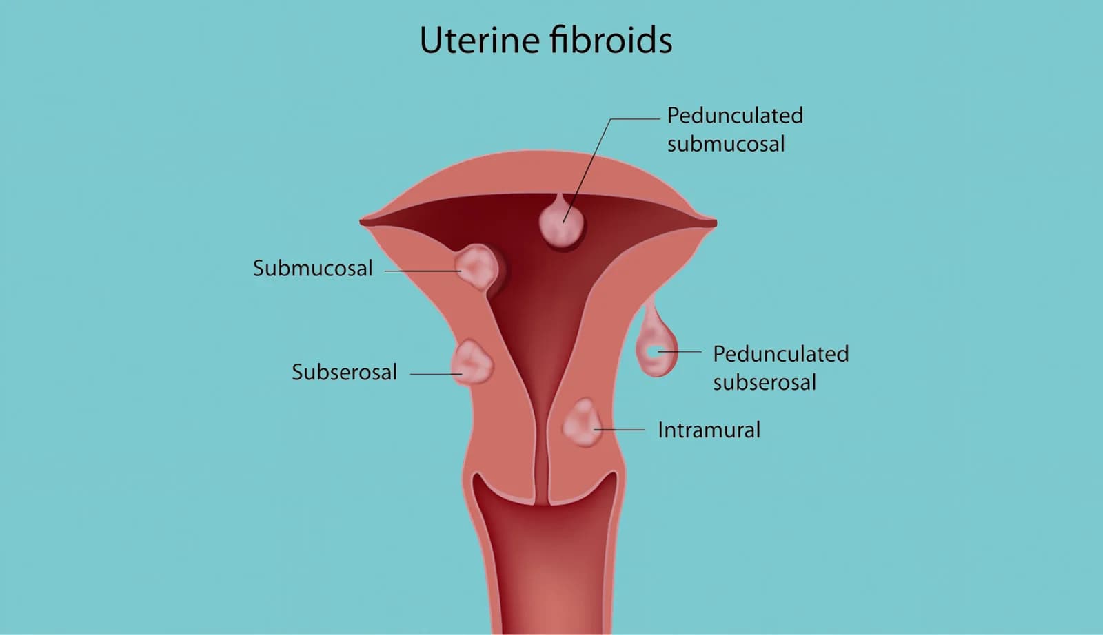 Best Uterine Evaluation in Delhi for Fertility Success | Fertylity IVF