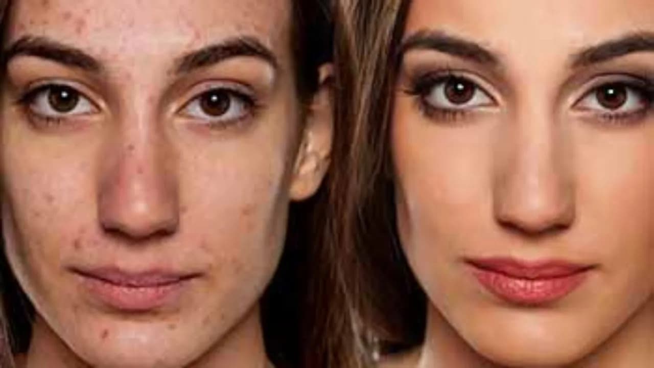 Enhance Your Profile with Non-Surgical Rhinoplasty Chiswick
