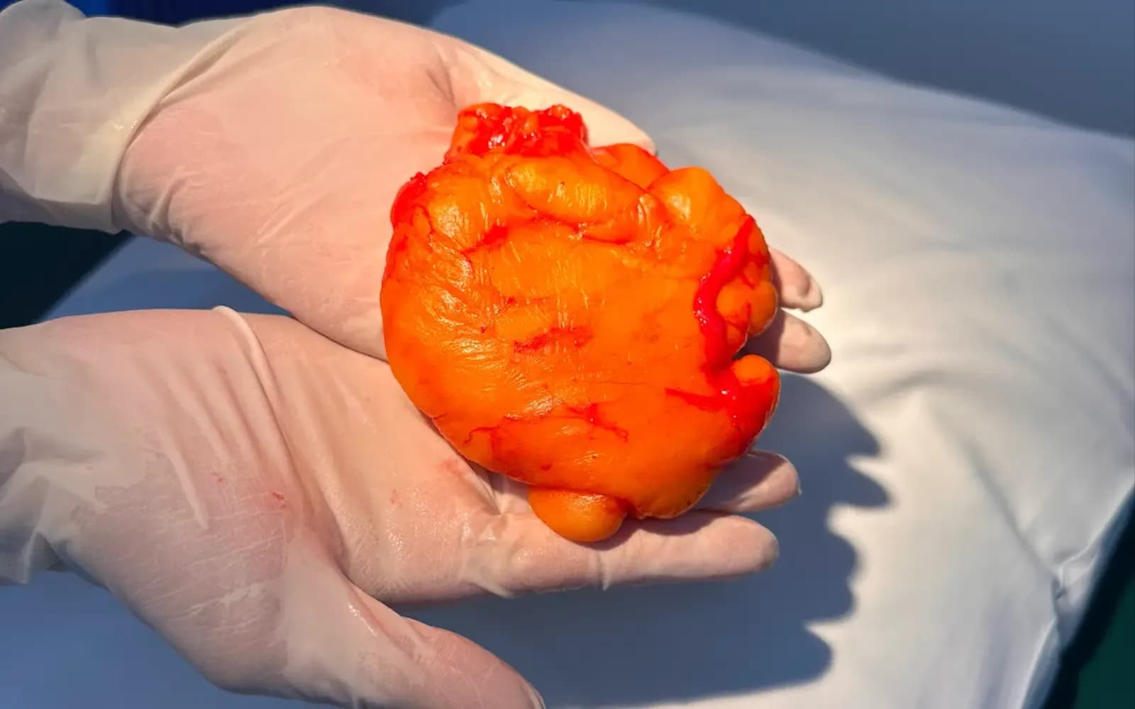 Learn What to Expect from Lipoma Removal Treatment