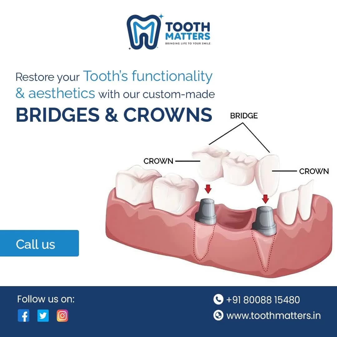 Dental Crown Solutions at Tooth Matters | Trusted Dental Clinic 