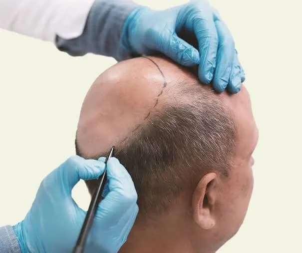Trust Us for the Best Hair Transplant in Melbourne for Natural Results