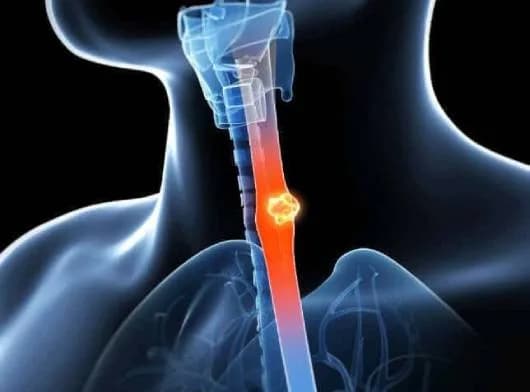 Leading Esophageal Cancer Doctor in Noida | Cancer Consult