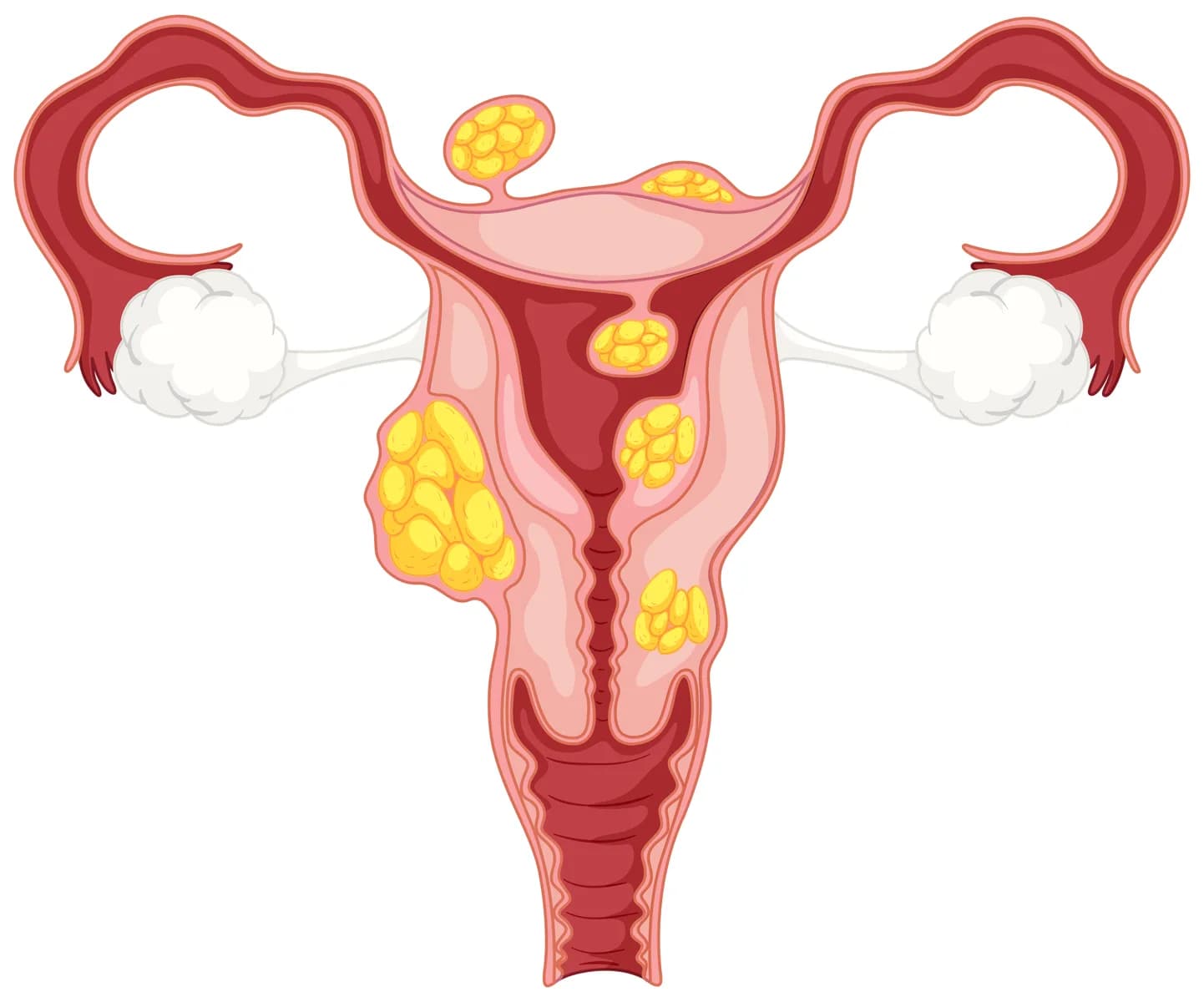 Local Fibroid Care in Union City, New Jersey