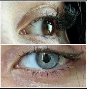 How To Lighten Eye Color: Available Options