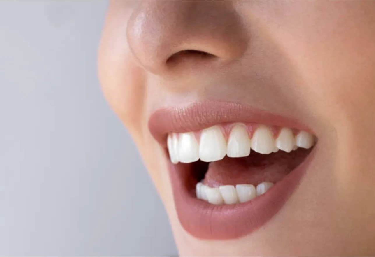 Tooth Color Fillings in Mount Roskill