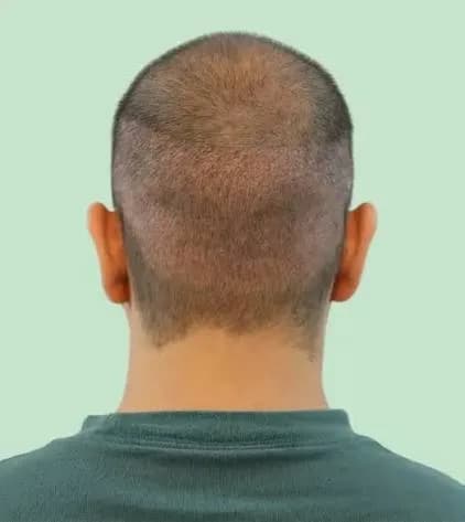 Most Trusted Clinic for FUE Hair Transplant in India— Natural Results, Zero Scars