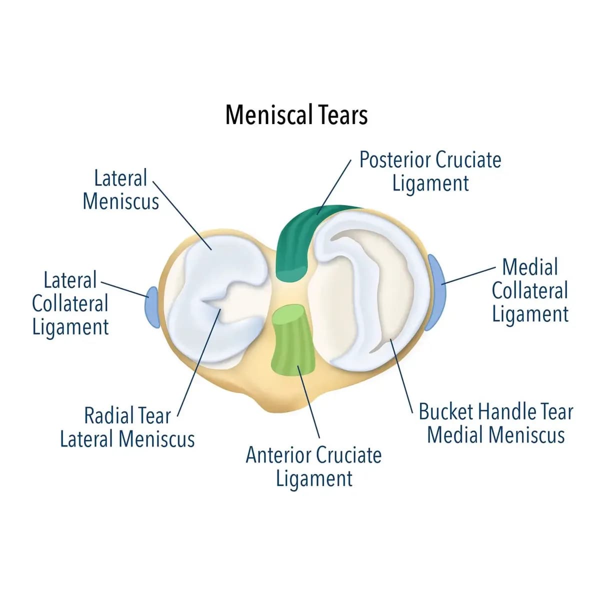 What Happens After a Knee Meniscal Tear Is Diagnosed