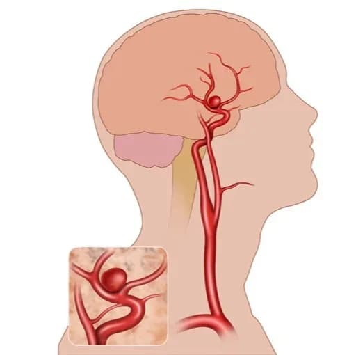 Coiling Surgery for Brain Aneurysm | Advanced Minimally Invasive Care