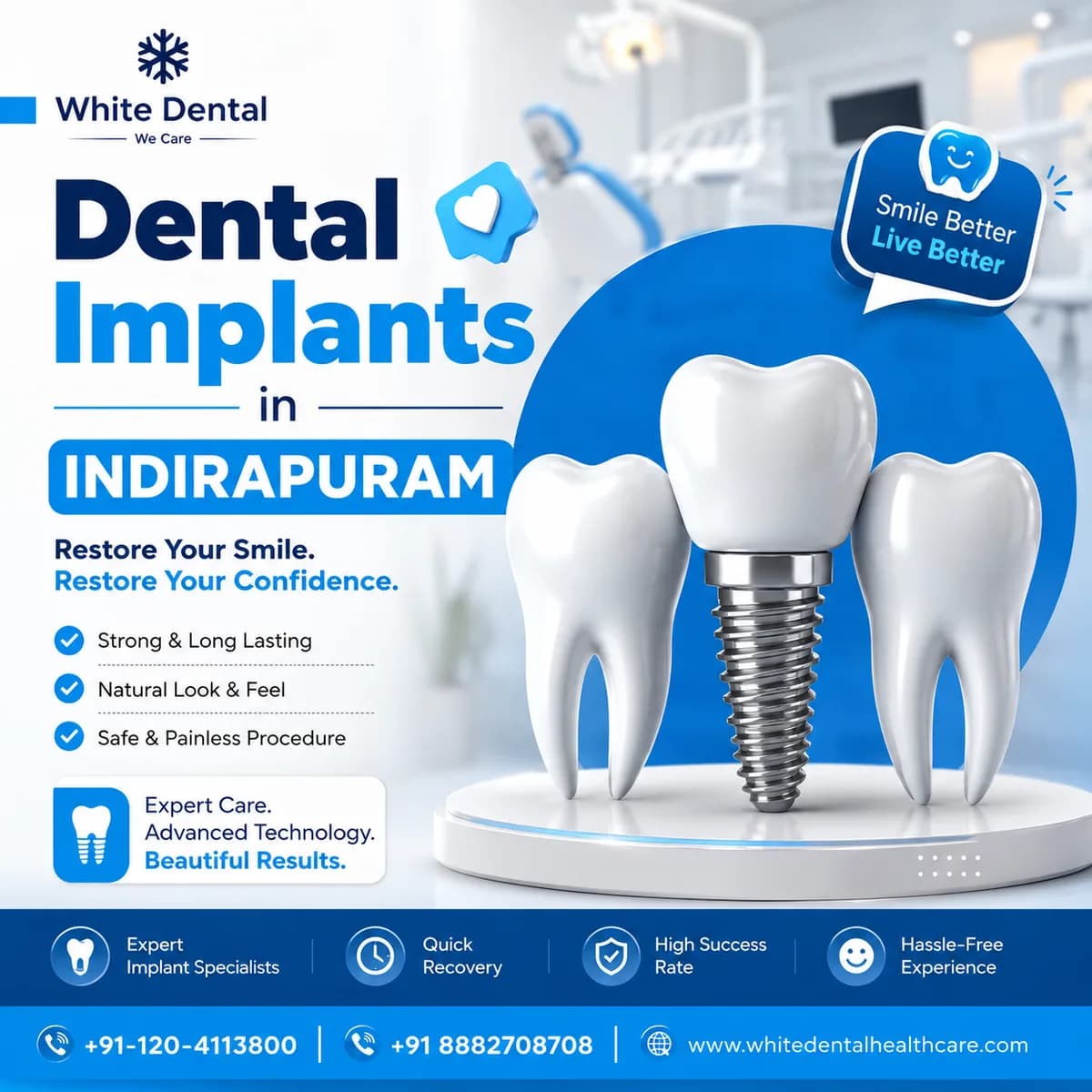 Dental Implants in Indirapuram for Permanent Tooth Replacement