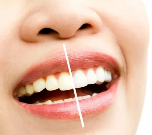 Professional Teeth Whitening PA Services Delivering Brighter Smiles