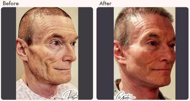 Facelift Surgery Cost In Delhi NCR - Dr Rajat Gupta