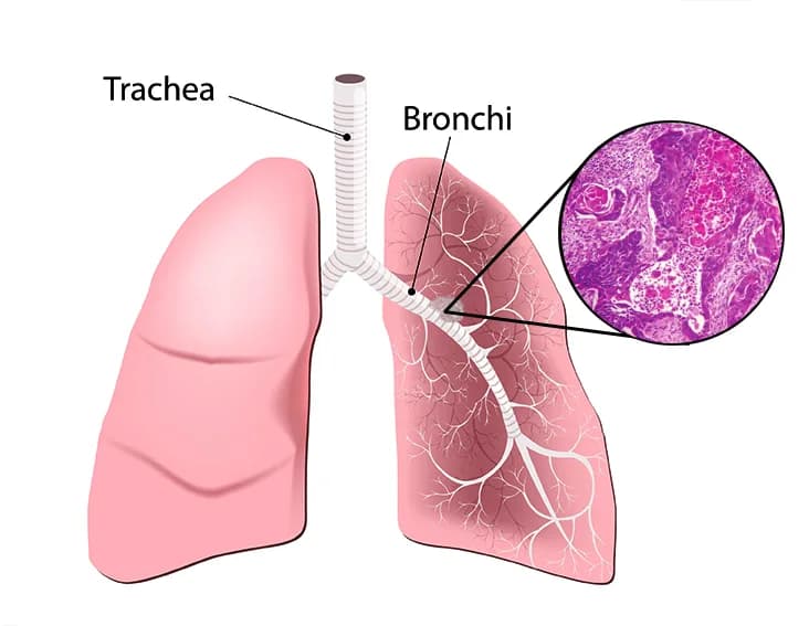 Expert Lung Cancer Treatment in Noida | Dr. Manish Singhal