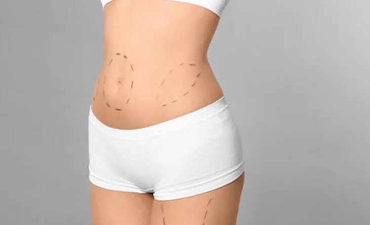 What Is the Cost of Liposuction Surgery?