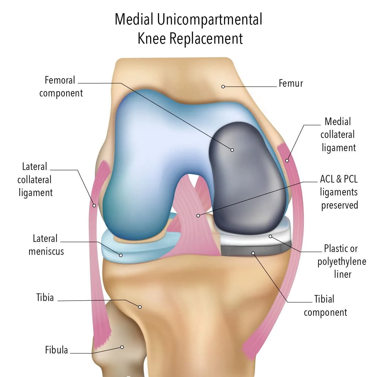Partial Knee Replacement Surgery for Damaged Knee Compartments 