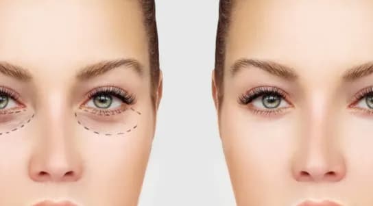 Enhance Your Appearance with Eyelid Surgery Windsor
