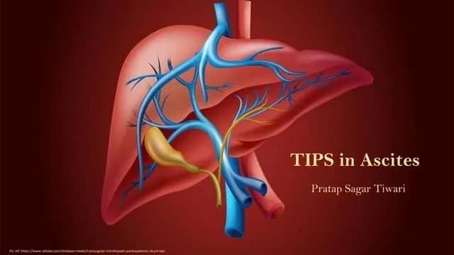  Minimally Invasive Approach to Treating Liver Complications Using TIPS Procedure Radiology