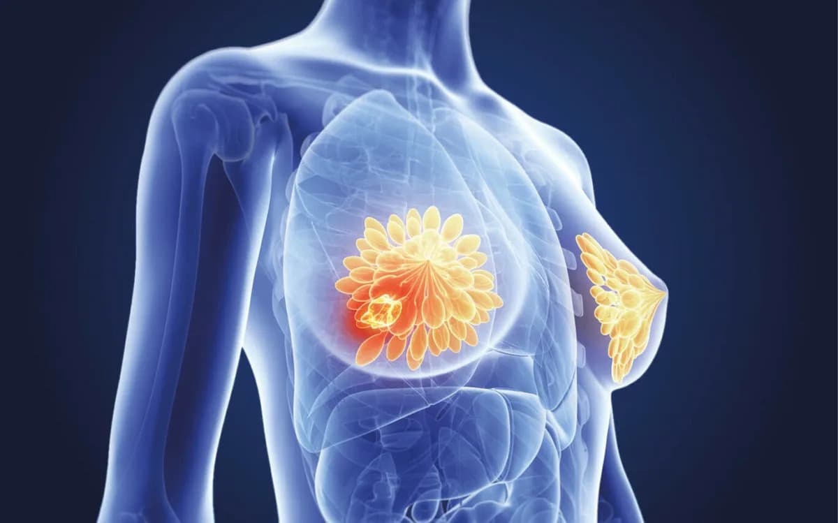 Best Breast Cancer Treatment in Noida by Dr Manish Singhal