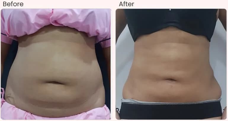 Liposuction Surgery in Delhi - Dr Rajat Gupta