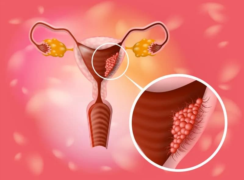 Best Care for Uterine Cancer Treatment in Noida by Specialists'
