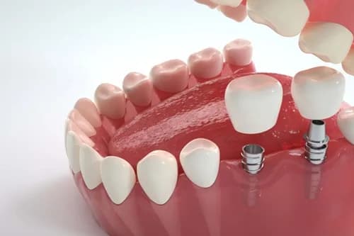 Dental Implants in PA Offering Reliable and Budget Friendly Tooth Replacement Solutions