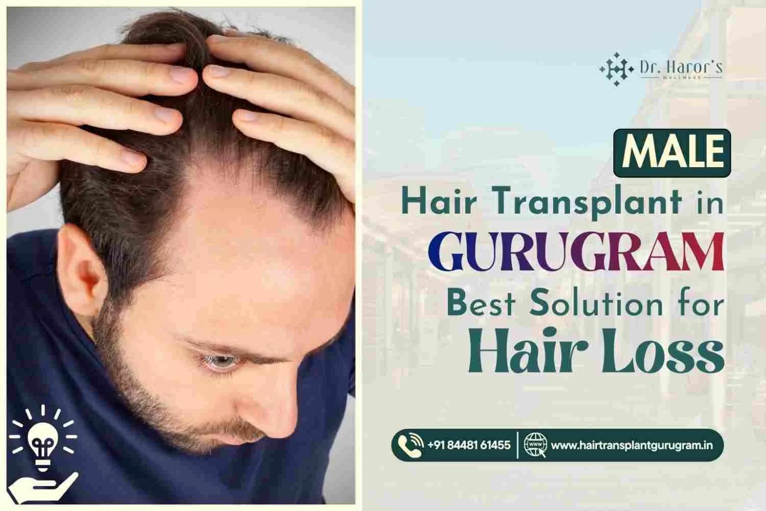 Hair Transplant Cost in Singapore: Price, Factors & Complete Guide