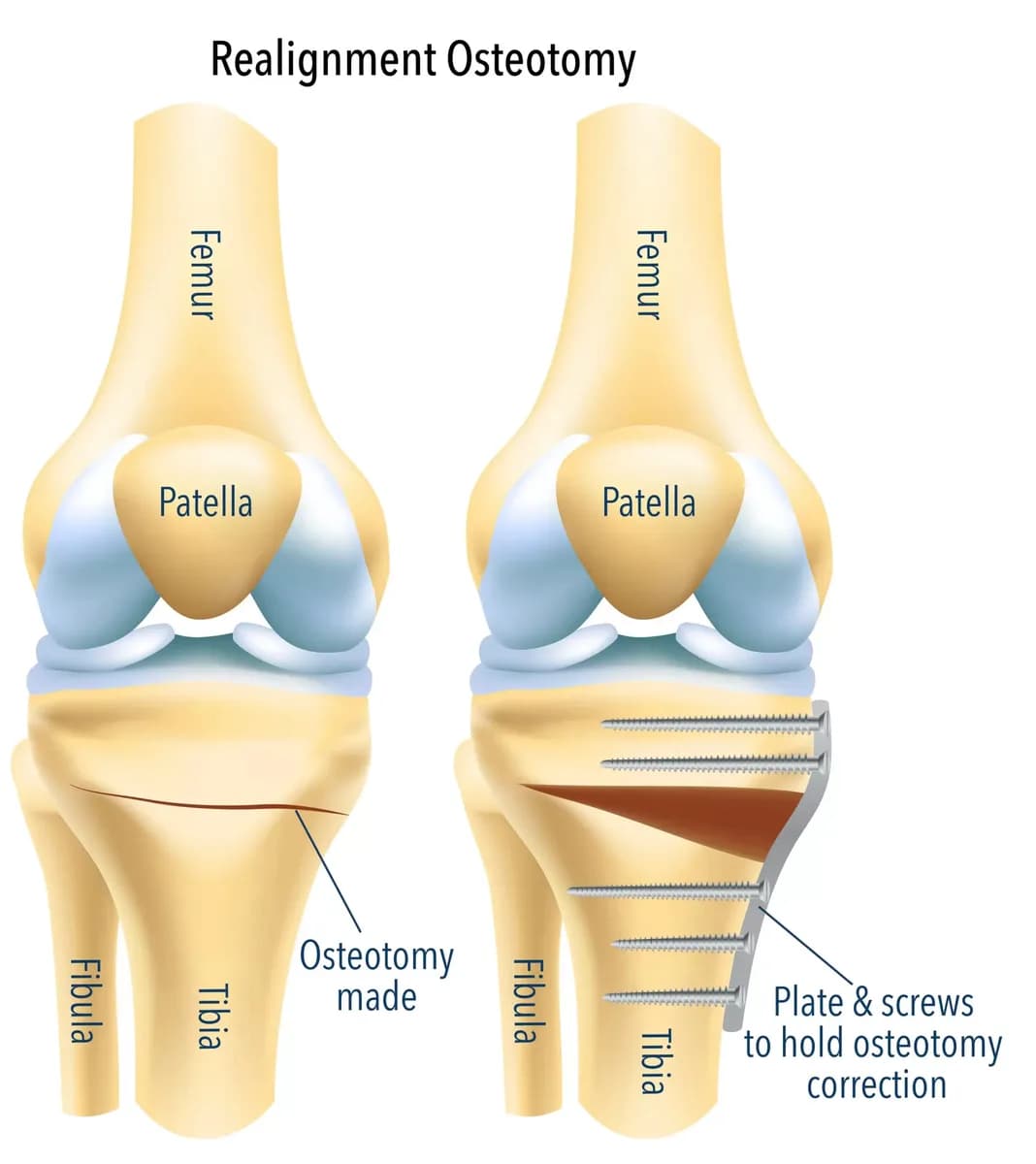 Protect Your Knee with Osteotomy Surgery