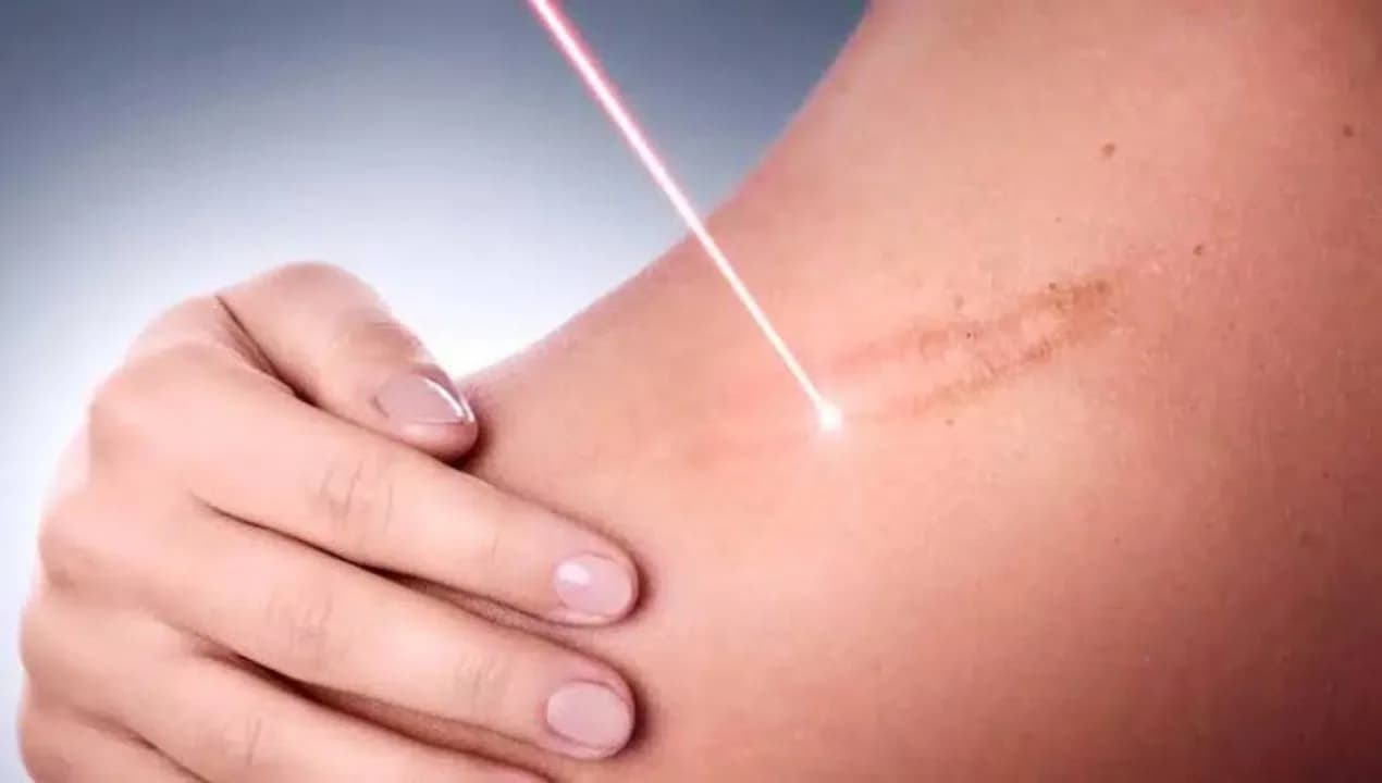 Safe and Effective Keloid Surgical Removal Services