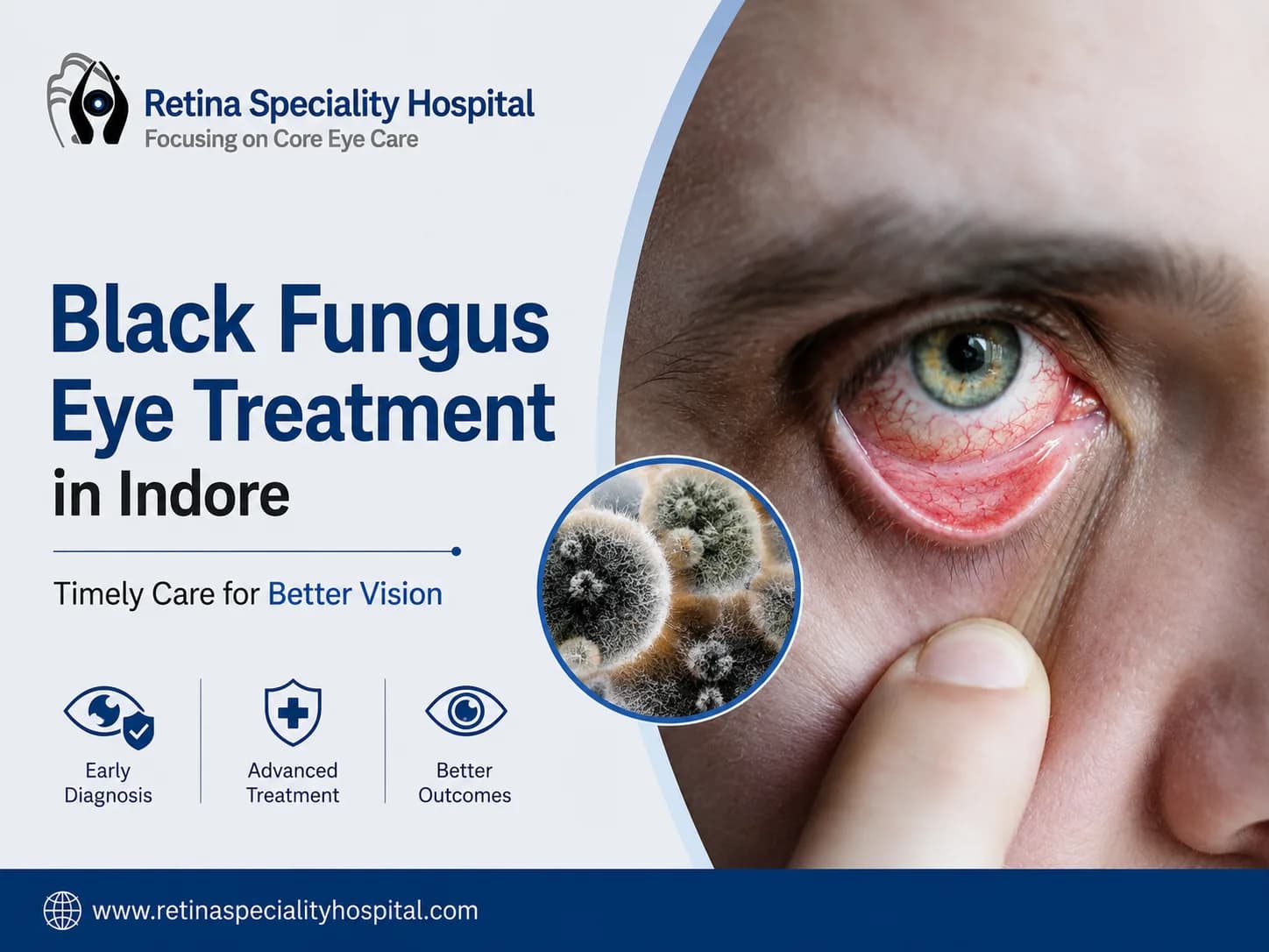 Black Fungus Eye Treatment in Indore: Early Diagnosis and Care!!!