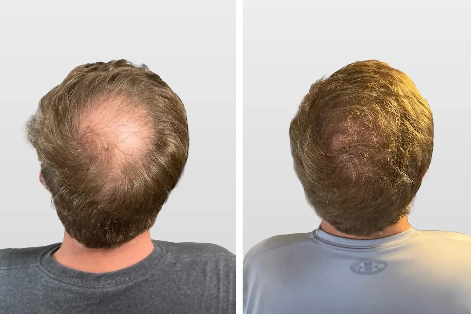 Hair Loss Solutions Dallas | Women’s Thinning Hair Specialist