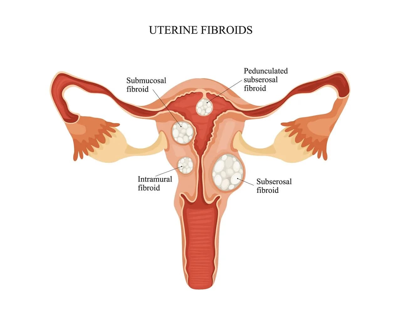 Detailed Uterine Evaluation in Delhi by Fertility Experts