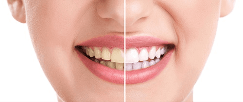 Professional Teeth Whitening Philly Services Helping Patients Achieve Brighter Confident Smiles