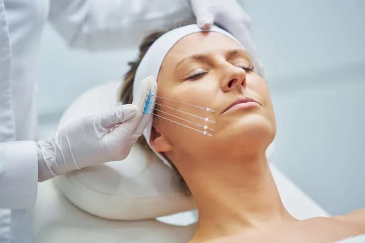Thread Lift Treatment in Delhi | Non Surgical Face Lift