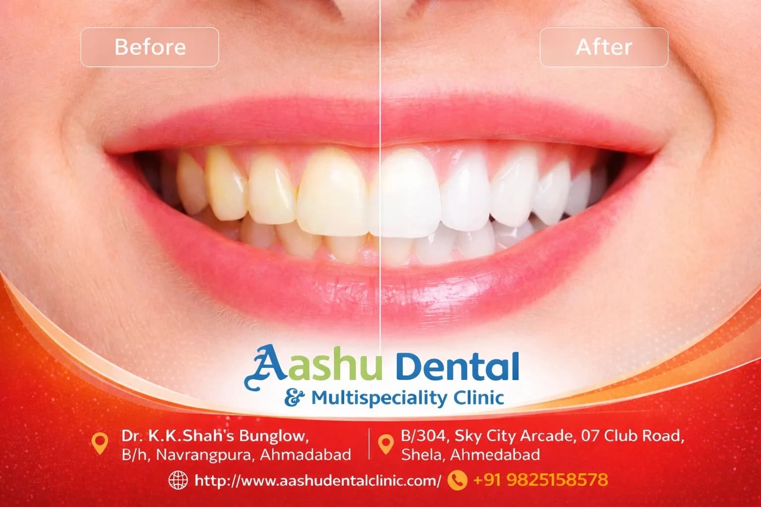 Restore Your Smile with Full Mouth Rehabilitation Treatment