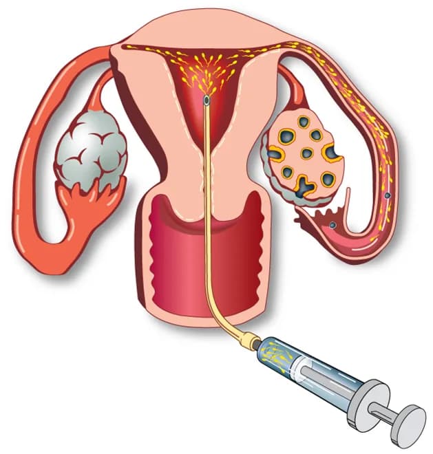 Trusted Intrauterine Insemination in Delhi at Fertylity IVF