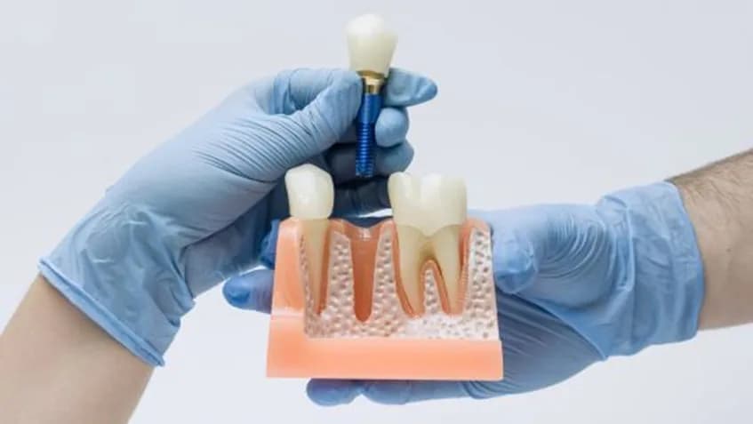 Dental Implants for a Natural-Looking, Confident Smile